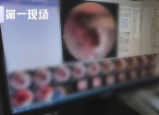 小伙脖子脓肿，开刀发现里面有7颗瓜子藏了20年