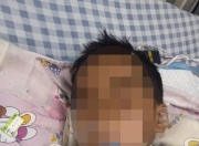 3岁男童扁桃体手术10天后脑死亡，当地卫健局已介入